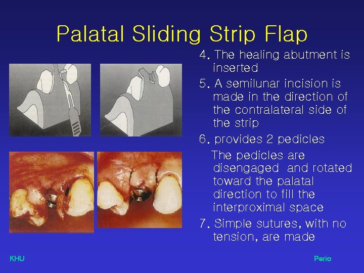 Palatal Sliding Strip Flap 4. The healing abutment is inserted 5. A semilunar incision