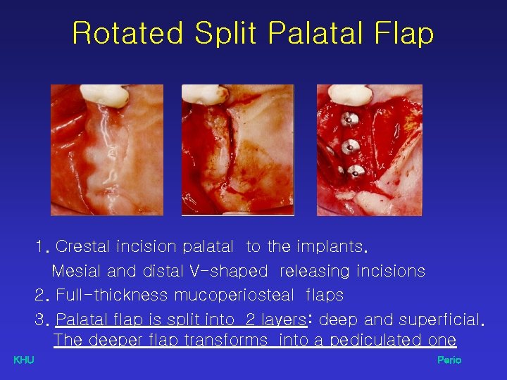 Rotated Split Palatal Flap 1. Crestal incision palatal to the implants. Mesial and distal