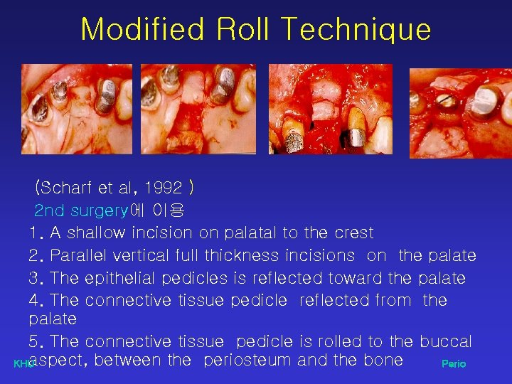 Modified Roll Technique (Scharf et al, 1992 ) 2 nd surgery에 이용 1. A