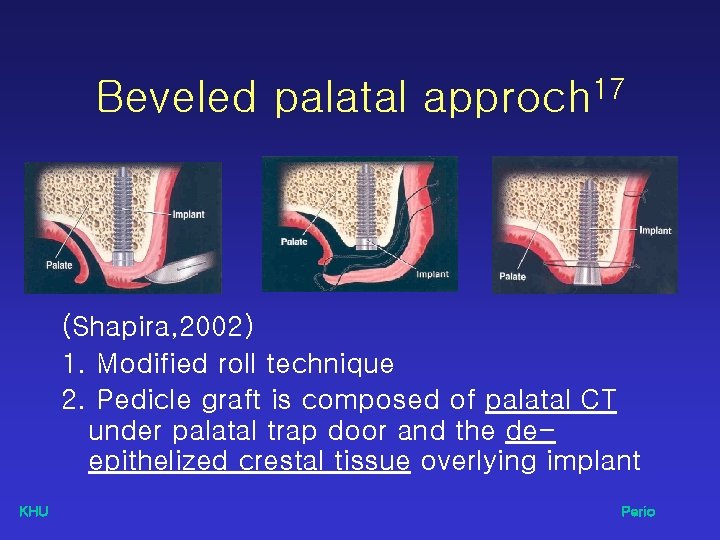 Beveled palatal approch 17 (Shapira, 2002) 1. Modified roll technique 2. Pedicle graft is