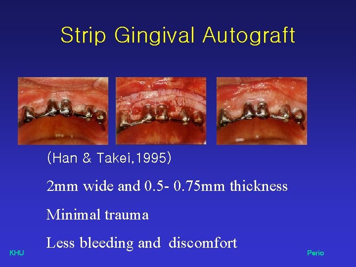 Strip Gingival Autograft (Han & Takei, 1995) 2 mm wide and 0. 5 -