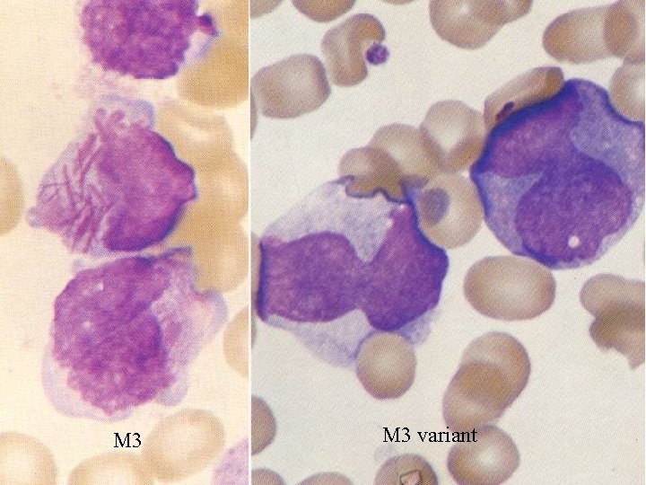 Leukemia Definition A heterogenous group of neoplasms arising