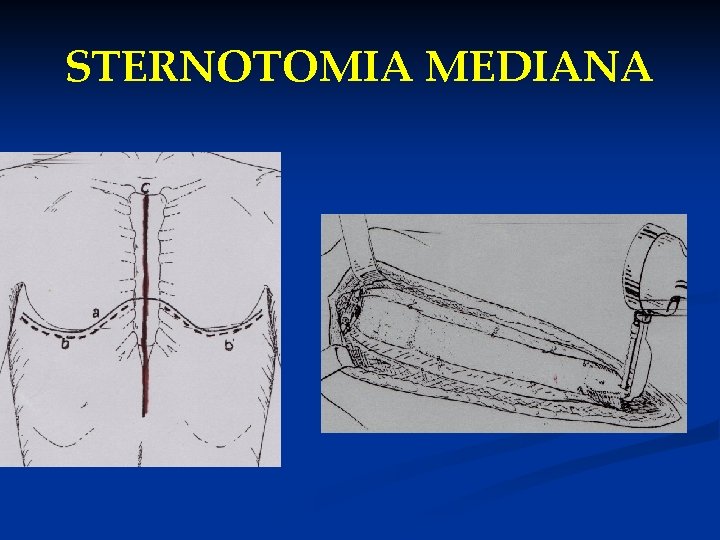 STERNOTOMIA MEDIANA 