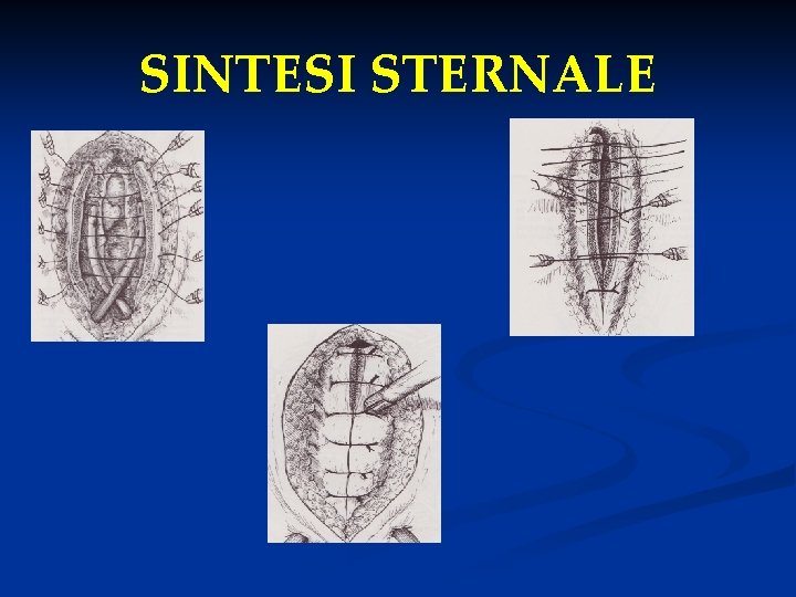 SINTESI STERNALE 