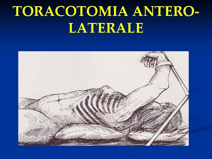 TORACOTOMIA ANTEROLATERALE 