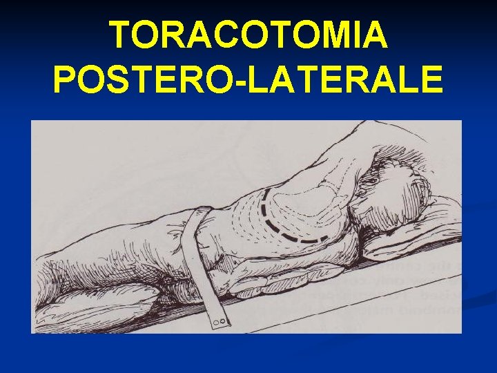 TORACOTOMIA POSTERO-LATERALE 