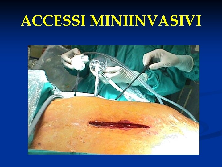 ACCESSI MINIINVASIVI 