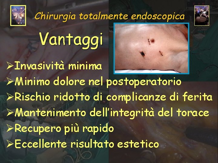 Chirurgia totalmente endoscopica Vantaggi ØInvasività minima ØMinimo dolore nel postoperatorio ØRischio ridotto di complicanze