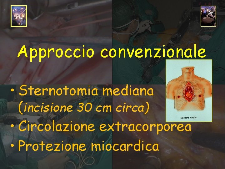 Approccio convenzionale • Sternotomia mediana (incisione 30 cm circa) • Circolazione extracorporea • Protezione