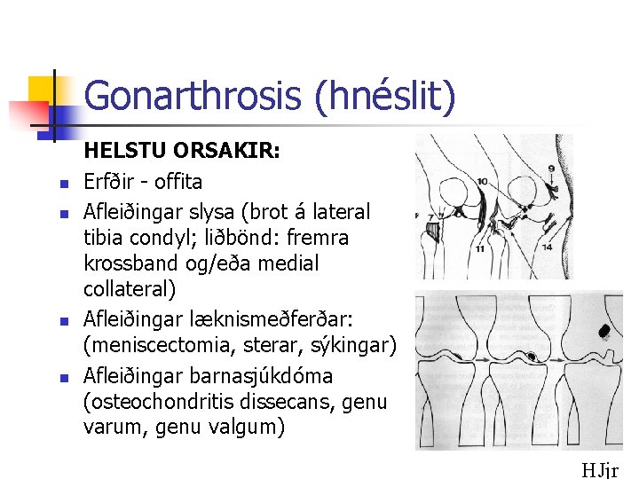 Gonarthrosis (hnéslit) n n HELSTU ORSAKIR: Erfðir - offita Afleiðingar slysa (brot á lateral