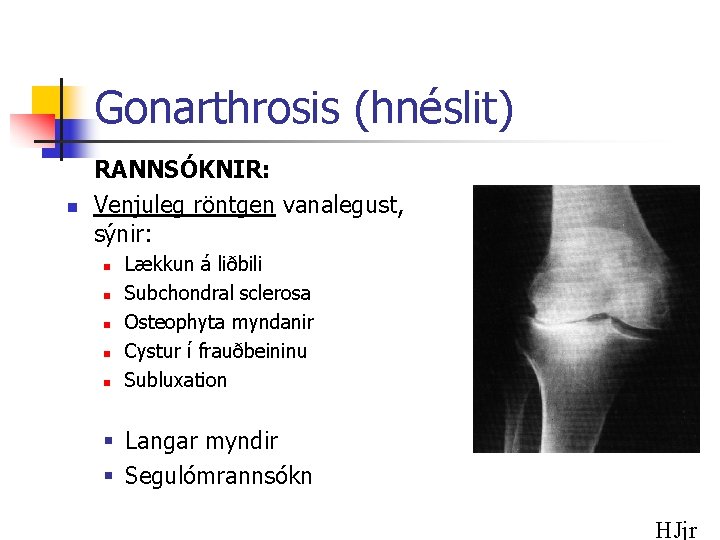 Gonarthrosis (hnéslit) n RANNSÓKNIR: Venjuleg röntgen vanalegust, sýnir: n n n Lækkun á liðbili