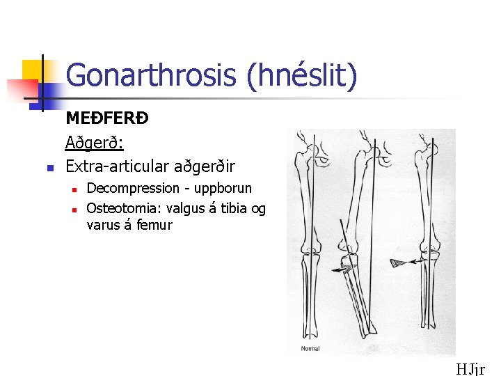 Gonarthrosis (hnéslit) n MEÐFERÐ Aðgerð: Extra-articular aðgerðir n n Decompression - uppborun Osteotomia: valgus