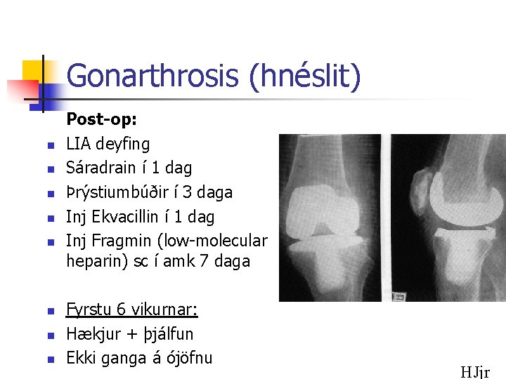 Gonarthrosis (hnéslit) n n n n Post-op: LIA deyfing Sáradrain í 1 dag Þrýstiumbúðir