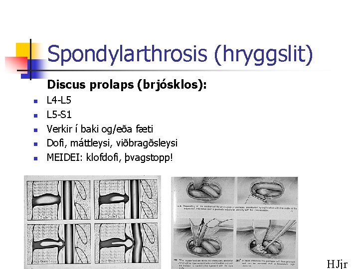 Spondylarthrosis (hryggslit) Discus prolaps (brjósklos): n n n L 4 -L 5 L 5