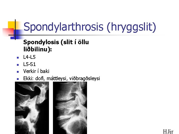 Spondylarthrosis (hryggslit) Spondylosis (slit í öllu liðbilinu): n n L 4 -L 5 L
