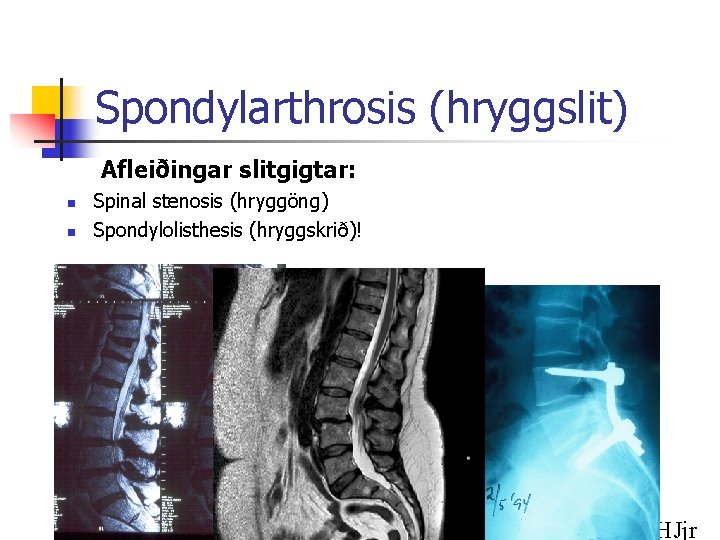 Spondylarthrosis (hryggslit) Afleiðingar slitgigtar: n n Spinal stenosis (hryggöng) Spondylolisthesis (hryggskrið)! HJjr 