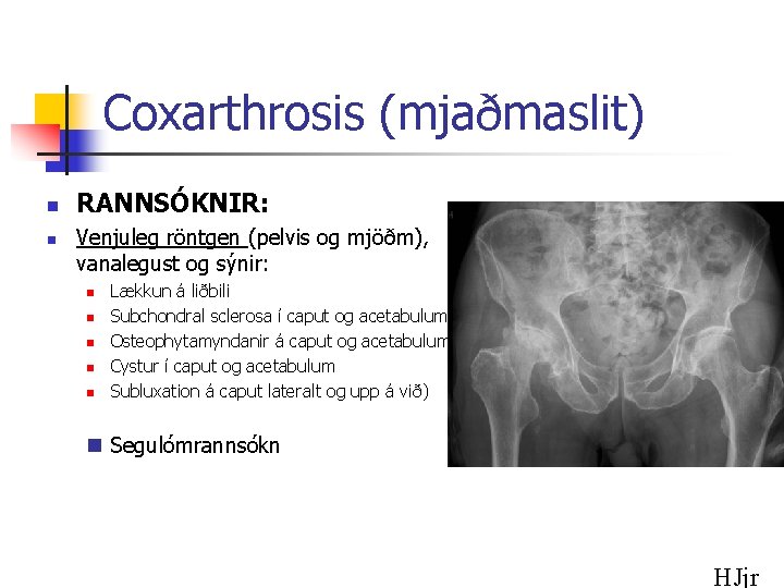 Coxarthrosis (mjaðmaslit) n n RANNSÓKNIR: Venjuleg röntgen (pelvis og mjöðm), vanalegust og sýnir: n