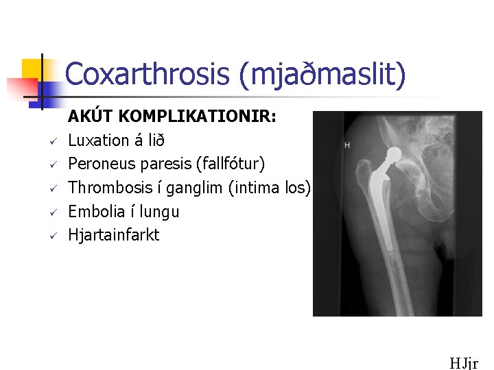 Coxarthrosis (mjaðmaslit) ü ü ü AKÚT KOMPLIKATIONIR: Luxation á lið Peroneus paresis (fallfótur) Thrombosis