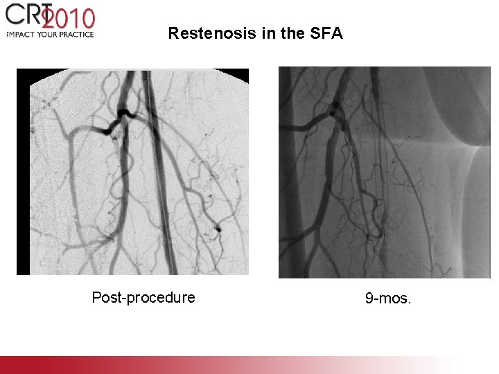 Restenosis in the SFA Post-procedure 9 -mos. Restenosis in the SFA Post-procedure 9 -mos.