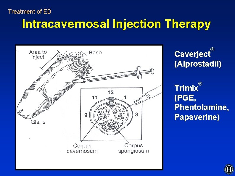 Treatment of ED Intracavernosal Injection Therapy ® Caverject (Alprostadil) ® Trimix (PGE, Phentolamine, Papaverine) Treatment of ED Intracavernosal Injection Therapy ® Caverject (Alprostadil) ® Trimix (PGE, Phentolamine, Papaverine)