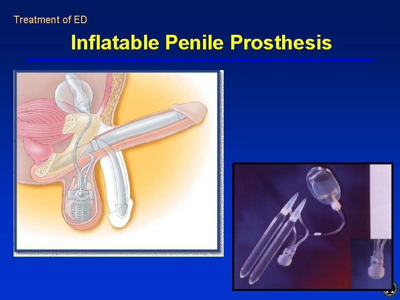Treatment of ED Inflatable Penile Prosthesis Treatment of ED Inflatable Penile Prosthesis