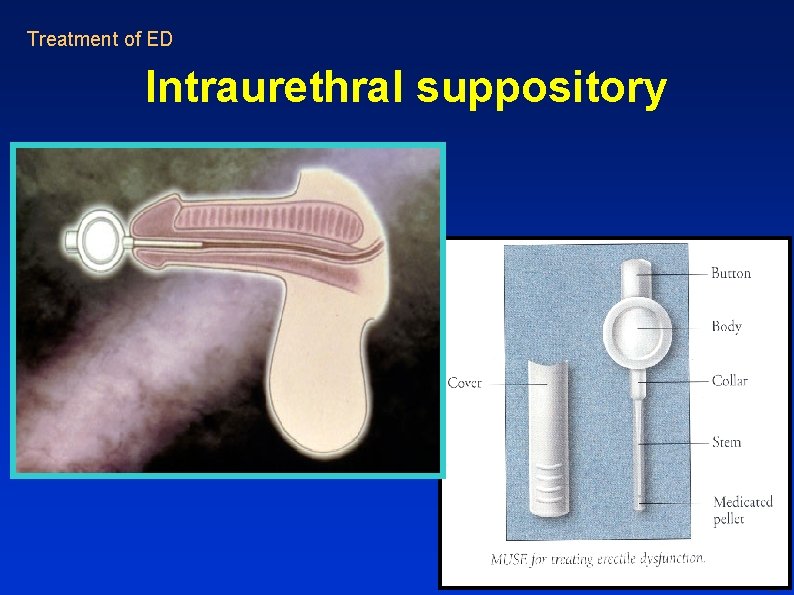Treatment of ED Intraurethral suppository Treatment of ED Intraurethral suppository