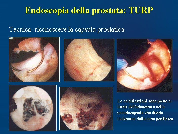 calcificazioni prostata)