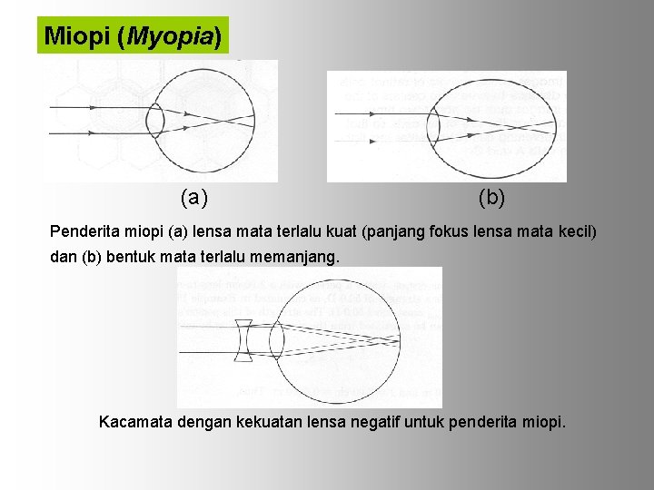 Miopi (Myopia) (b) Penderita miopi (a) lensa mata terlalu kuat (panjang fokus lensa mata