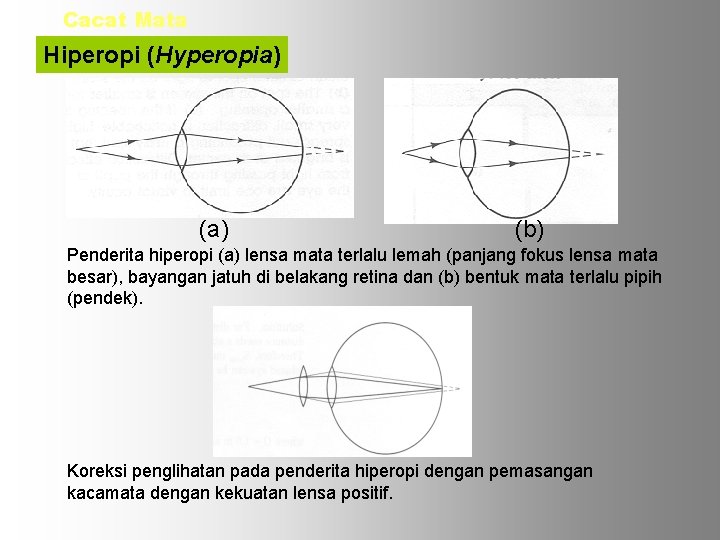 Cacat Mata Hiperopi (Hyperopia) (b) Penderita hiperopi (a) lensa mata terlalu lemah (panjang fokus