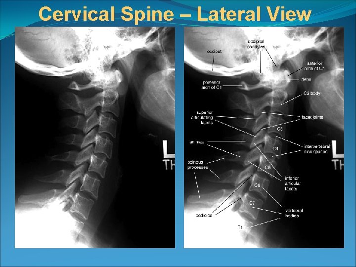 Introduction To Neuroimaging Spine Ayegl Sarslmaz Md Radiology