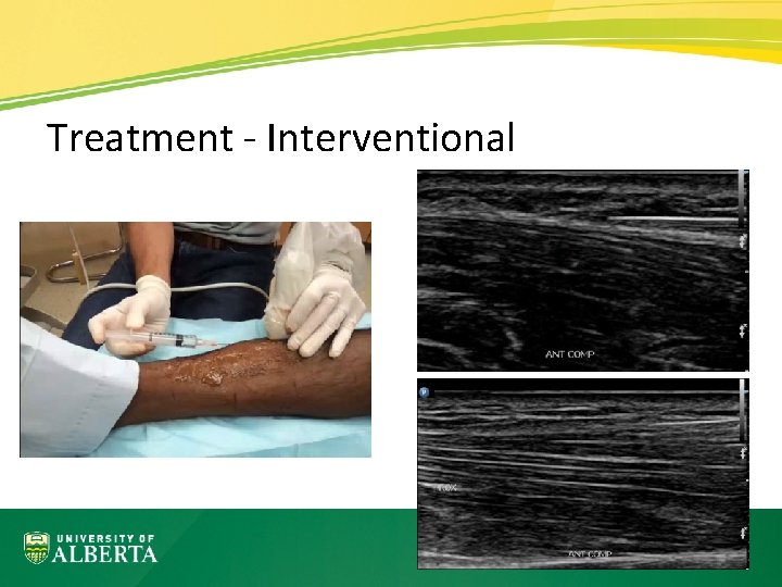Treatment - Interventional 