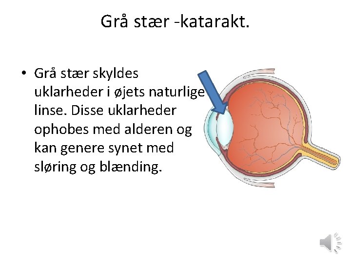 Grå stær -katarakt. • Grå stær skyldes uklarheder i øjets naturlige linse. Disse uklarheder