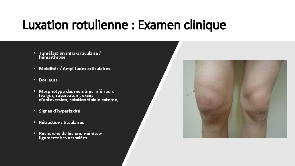 Luxation rotulienne : Examen clinique • Tuméfaction intra-articulaire / hémarthrose • Mobilités / Amplitudes