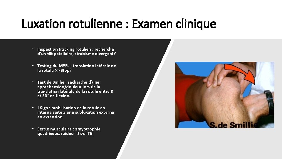 Luxation rotulienne : Examen clinique • Inspection tracking rotulien : recherche d’un tilt patellaire,