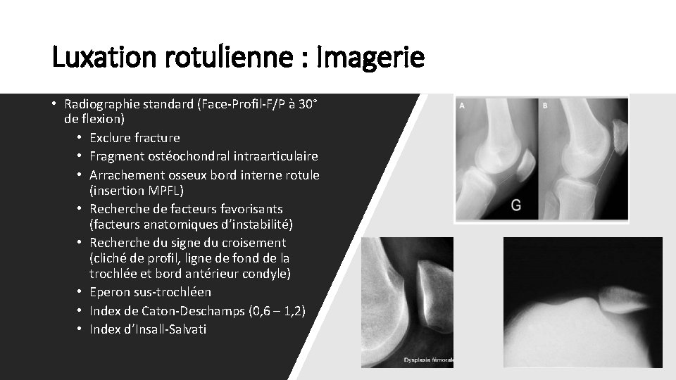 Luxation rotulienne : Imagerie • Radiographie standard (Face-Profil-F/P à 30° de flexion) • Exclure