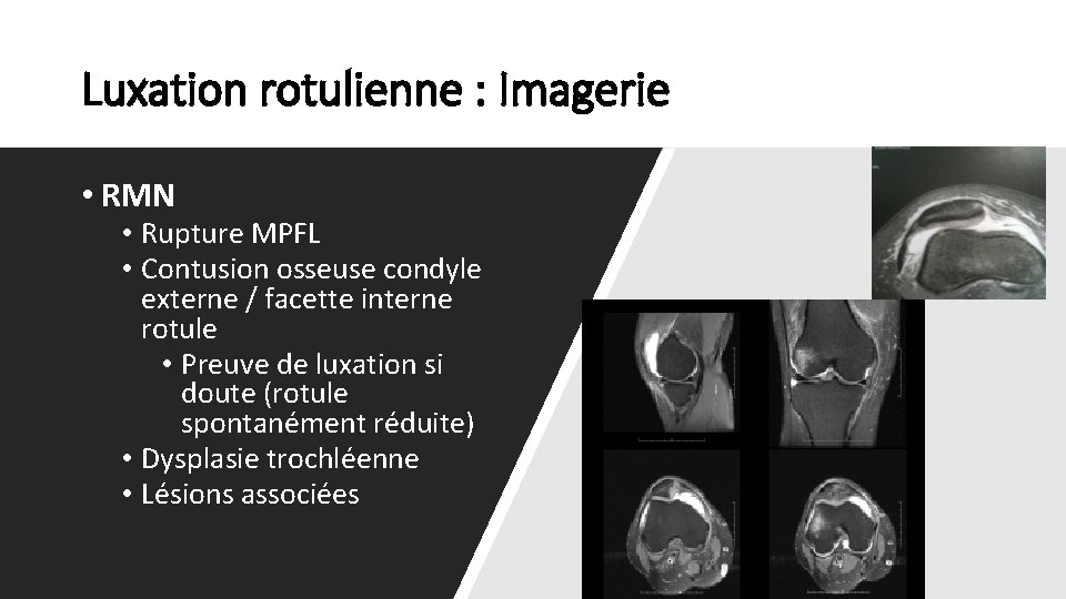 Luxation rotulienne : Imagerie • RMN • Rupture MPFL • Contusion osseuse condyle externe