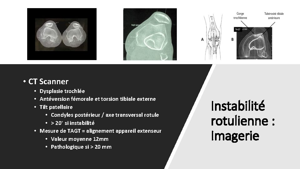  • CT Scanner • Dysplasie trochlée • Antéversion fémorale et torsion tibiale externe