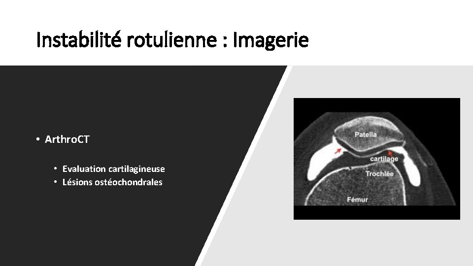 Instabilité rotulienne : Imagerie • Arthro. CT • Evaluation cartilagineuse • Lésions ostéochondrales 