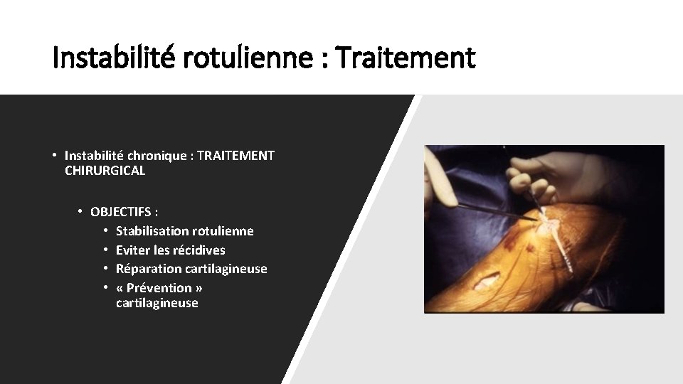 Instabilité rotulienne : Traitement • Instabilité chronique : TRAITEMENT CHIRURGICAL • OBJECTIFS : •