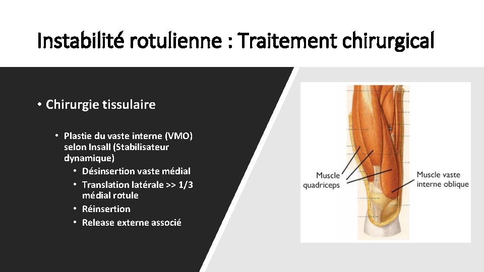Instabilité rotulienne : Traitement chirurgical • Chirurgie tissulaire • Plastie du vaste interne (VMO)