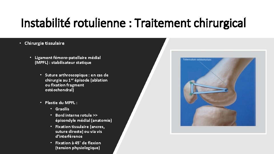Instabilité rotulienne : Traitement chirurgical • Chirurgie tissulaire • Ligament fémoro-patellaire médial (MPFL) :