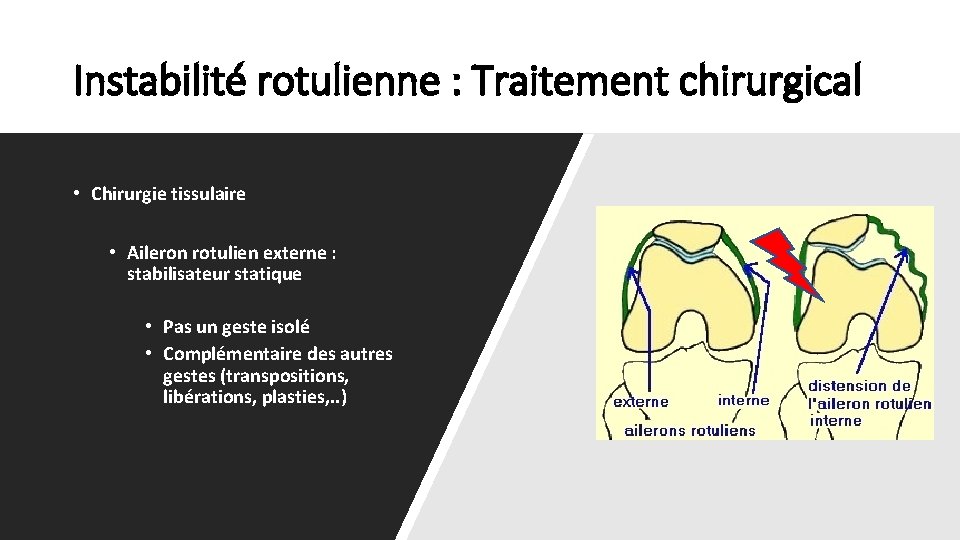 Instabilité rotulienne : Traitement chirurgical • Chirurgie tissulaire • Aileron rotulien externe : stabilisateur