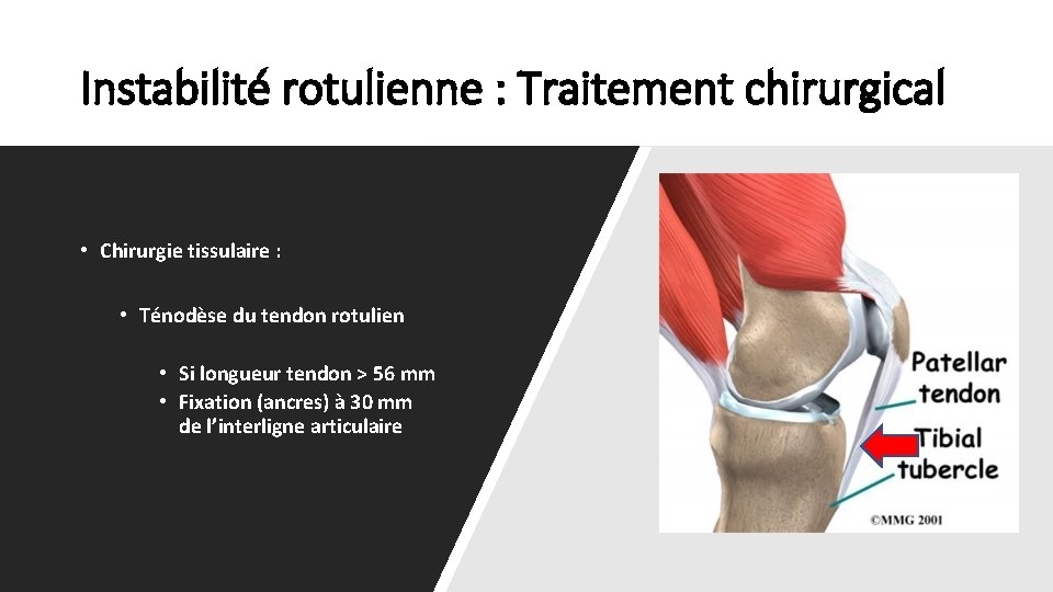 Instabilité rotulienne : Traitement chirurgical • Chirurgie tissulaire : • Ténodèse du tendon rotulien