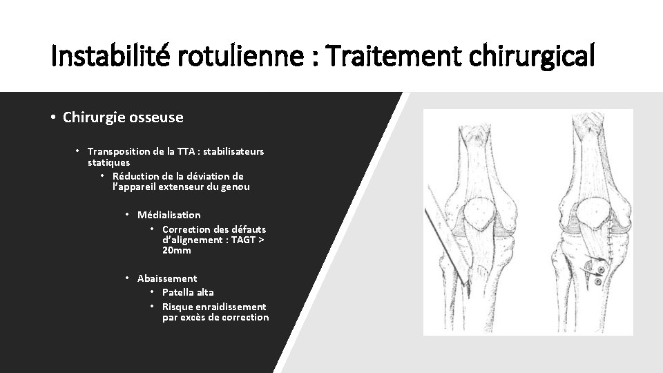 Instabilité rotulienne : Traitement chirurgical • Chirurgie osseuse • Transposition de la TTA :