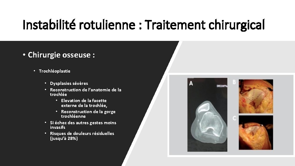 Instabilité rotulienne : Traitement chirurgical • Chirurgie osseuse : • Trochléoplastie • Dysplasies sévères