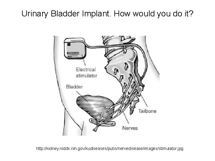 Urinary Bladder Implant. How would you do it? http: //kidney. niddk. nih. gov/kudiseases/pubs/nervedisease/images/stimulator. jpg