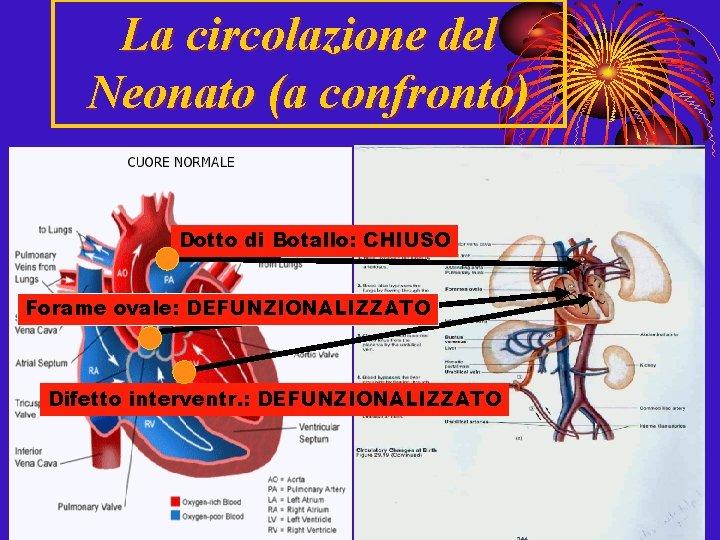 La circolazione del Neonato (a confronto) Dotto di Botallo: CHIUSO Forame ovale: DEFUNZIONALIZZATO Difetto