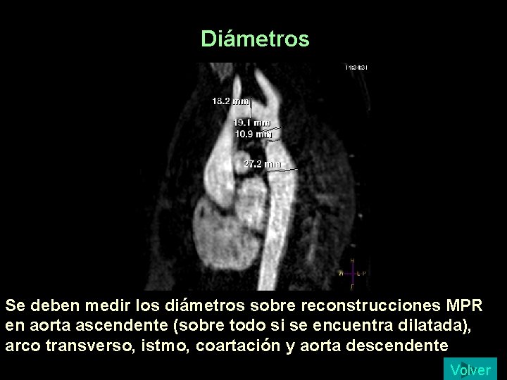 Diámetros Se deben medir los diámetros sobre reconstrucciones MPR en aorta ascendente (sobre todo Diámetros Se deben medir los diámetros sobre reconstrucciones MPR en aorta ascendente (sobre todo