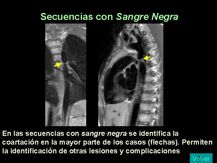 Secuencias con Sangre Negra En las secuencias con sangre negra se identifica la coartación Secuencias con Sangre Negra En las secuencias con sangre negra se identifica la coartación