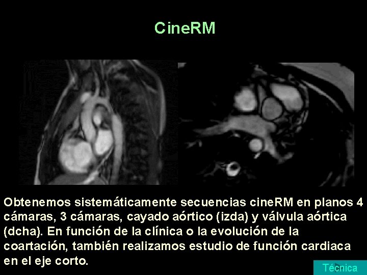 Cine. RM Obtenemos sistemáticamente secuencias cine. RM en planos 4 cámaras, 3 cámaras, cayado Cine. RM Obtenemos sistemáticamente secuencias cine. RM en planos 4 cámaras, 3 cámaras, cayado